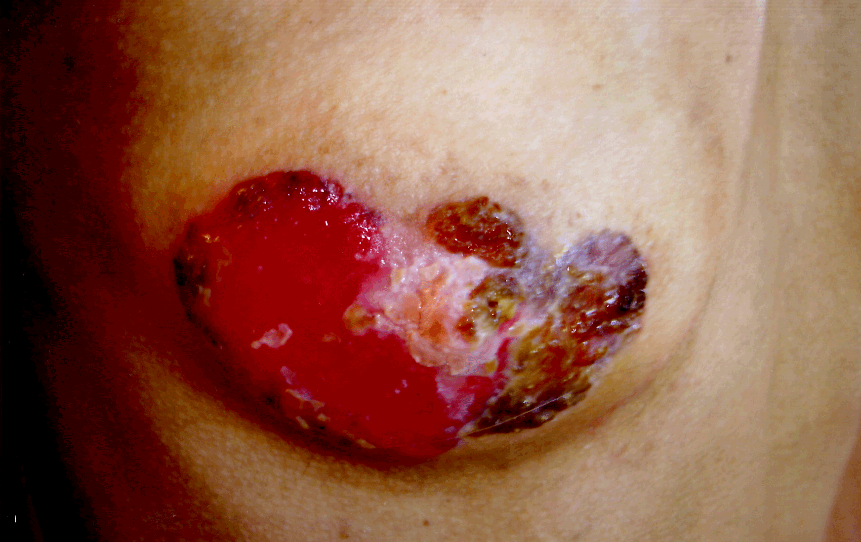 Paget Disease 2005