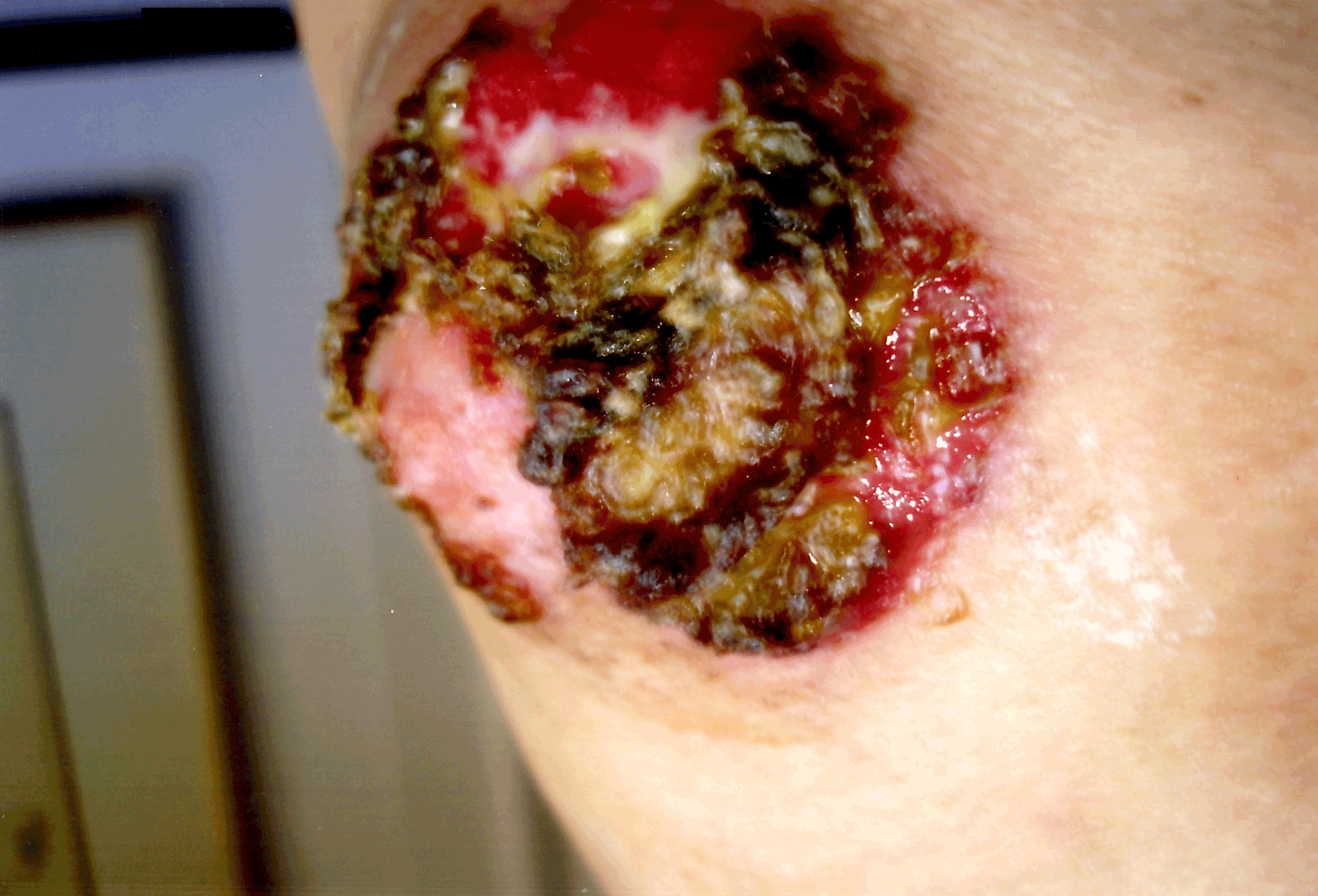 'Paget-Disease' 2007